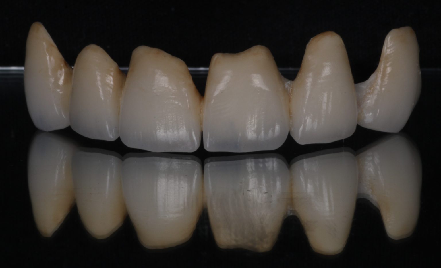 DMLS CAD/CAM PFM Grooves Dental Deisgn